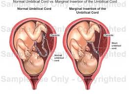Insertion of the umbilical cord within <2 cm from the placental margin is described as marginal cord insertion (usually defined as <2 cm 5 although some references define it as <1 cm 3,6). Kal Atluri Kalatluri Profile Pinterest