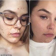 Banish those blemishes and get glowing skin! Women Are Banishing Their Acne In Only Days Using These Vitamins But They Ll Set You Back 44 99 Daily Mail Online