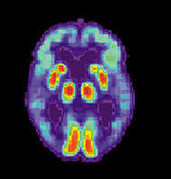Alzheimers derimod er en bestemt sygdom, hvor lægerne ved præcis, hvilke ændringer der sker i hjernen. Alzheimers Sykdom Wikipedia