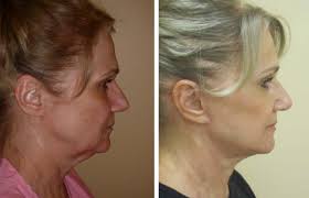 Anesthesiology, emergency medicine, hospital medicine How Much Does A Facelift Cost Plymouth Meeting Facelift The Pennsylvania Centre For Plastic Surgery