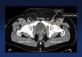 • to assess equivocal imaging findings • staging of hepatic neoplasms • metastatic workup of primary malignancies • diagnosis of abdominal masses • assessment of biliary problems • diagnosis of vascular lesions. Ctisus Com Vaccinated On Twitter Ct Pelvic Anatomy Medtwitter Radiology Radres