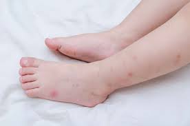 Maybe you would like to learn more about one of these? Comment Reconnaitre Une Piqure De Punaise De Lit