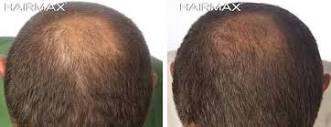 Before and After Plus Clinical Results Photos of Hair Growth – Hairmax