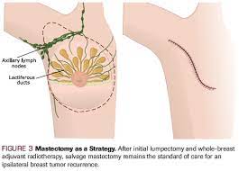 Male breast cancer exhibits the same symptoms as female breast cancer, including a lump. Current Strategies For The Management Of Locoregional Breast Cancer Recurrence