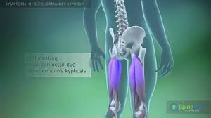Abnormal curvature of the spine. Scheuermann S Kyphosis Symptoms Youtube