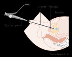 Trans Urethral Resection Of Bladder Tumour Turbt Bladder Cancer Cancer Research Uk