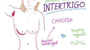 A consistent expression candidate is intertrigo. Intertrigo Youtube