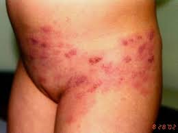 Se caracterizeaza prin durere si aparitia unei benzi eruptive ce se intinde pe o singura parte a corpului. Poze Medicale Zona Zoster