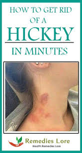 Pin On Remedies Lore
