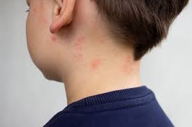 Image result for Measles