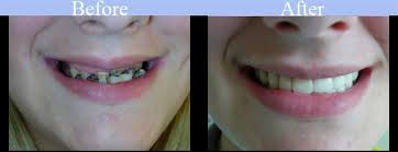 A removable partial denture (rpd) is a denture for a partially edentulous patient who desires to have replacement teeth for functional or aesthetic reasons and who cannot have a bridge (a fixed partial denture) any reason, such as a lack of required teeth to serve as support for a bridge. Before After Gallery Beautiful Smiles Denture Dental Office In Bothell