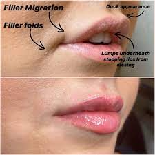 Prior to injecting the filler into the lips, the patient's medical history must be reviewed, and a facial. Has My Lip Filler Migrated Are My Lips Normal L1p