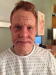 The dioxin disaster, 30 years later. Scream Queens Dioxin Poisoning Makeup Vincent Van Dyke Effects