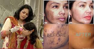 Get Rid Of Dark Spots And Freckles On Face Life Care Videos Dark Spots On Face Remove Dark Spots Face Serum Dark Spots