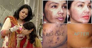 Dark spots, usually due to hyperpigmentation, are a common issue for people with black skin. Get Rid Of Dark Spots And Freckles On Face Life Care Videos Dark Spots On Face Remove Dark Spots Face Serum Dark Spots