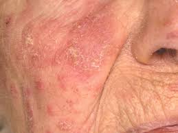 Image result for Eczema nummulare
