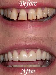 Angry Dental Care Heal Cavities Teethwhitening Dentalhygienisttshirts Dental Cosmetics Dental Cosmetic Dentistry Cosmetic Dentistry Cost