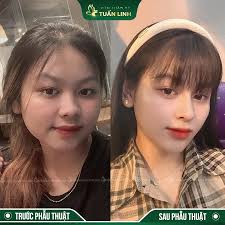 11 địa chỉ nâng mũi TPHCM uy tín, đẹp và an toàn nhất