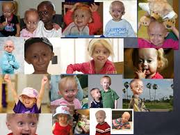 Image result for progeria case in bihar