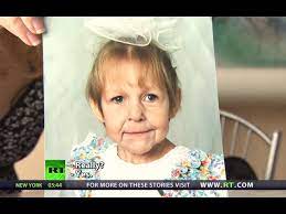 Disease that makes you look old. Curious Case Of My Face Young Souls Despite Old Looks Rt Documentary Youtube