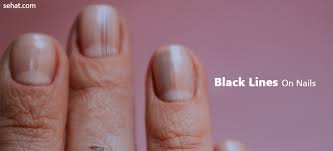 Maybe you would like to learn more about one of these? Black Lines On Nails Causes And Tips To Get Rid