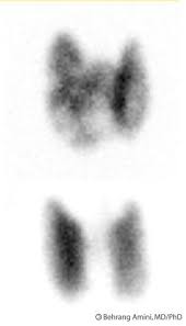 Image result for Multinodular Goiter