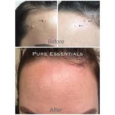 Ideally you will treat the cherry angiomas twice a day. Pure Essentials Lash Extensions Skin Care Makeup Mole Cherry Angioma Removal 31 Years Old Caucasian Female Before Photos Removed One Mole And Three Cherry Angiomas In Aug 18 After