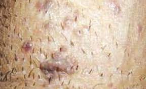 أيهما تتلاقى نزول الثآليل التناسلية عند الرجال بالصور dsvdedommel com