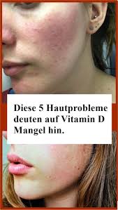 Vitamin d ist eine gruppe fettlöslicher vitamine, die zu den secosteroiden gehören und in der physiologie vor allem für ihre rolle beim calciumstoffwechsel bekannt sind. Diese 5 Hautprobleme Deuten Auf Vitamin D Mangel Hin Njuskam Beauty Hacks Beauty Vitamins