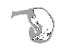 Image result for Breech Delivery