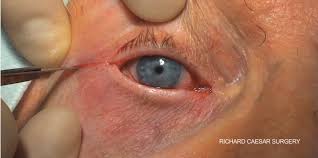 Image result for Lateral Canthotomy