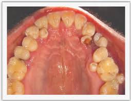 Des moines, desimones, demonises, desmosine. Jcdr Supernumerary Teeth Dental Anomalies Mesiodens Paramolars Distomolars Supplemental Teeth