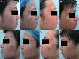 Topical 5-aminolevulinic photodynamic therapy with red light vs intense  pulsed light for the treatment of acne vulgaris: A spili