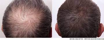 The vampire facial utilizes your own blood to achieve more supple, youthful skin, but now there is a similar treatment for hair loss. Prp Therapy Vampire Hair Treatments Smooth Synergy Medical Spa Laser Center