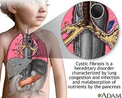 Cystic fibrosis liver disease | clinical research workshop. Cystic Fibrosis Medlineplus Medical Encyclopedia