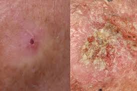 Merkel cell cancer is also referred to as neuroendocrine carcinoma of the skin. Skin Cancer Pictures 5 Different Types Of Skin Cancer To Know