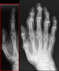 L'arthrose est une maladie inflammatoire qui se manifeste par des douleurs au niveau des articulations. Arthrose Wikipedia