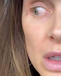 Vanderpump Rules" alum Lala Kent revealed she has an abnormality in her eye  that is pre-cancerous after breaking down in tears over her health  struggles earlier this week. See her statement at