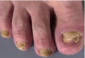 Image result for Yellow nail syndrome feet