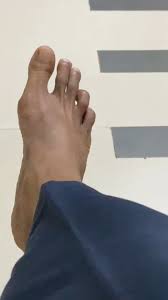 Image result for Koilonychia feet