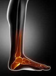 Petit ostéophytose de la face dorsal de l'arriére pied. Douleur Des Pieds Symptomes Traitement Definition Docteurclic Com