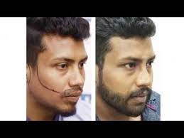 Alcs offers the best facial hair transplant in jaipur. Beard Transplant Restoration Case Dhi Direct Technique Beard Transplant Youtube