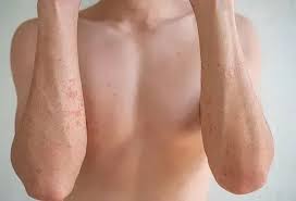 Image result for Atopic eczema atopic dermatitis