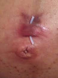 Infected Belly Button Piercing May 2014 Babies Forums What To Expect