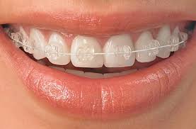 You're more likely to be complimented for having a beautiful smile and straight teeth are better for your oral health, too. Invisible Braces Orthodontist Hereford