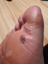 Maybe you would like to learn more about one of these? Cleaned My Foot Blood Blister Or Something Worse Should I Still Be Worried Skincareaddicts