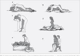 Figure 4 from [POSSIBILITIES AND LIMITATIONS OF SEXUAL ACTIVITY FOLLOWING  TOTAL HIP REPLACEMENT]. | Semantic Scholar