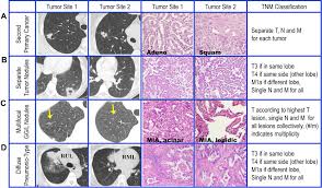 Tobacco use is the most common cause, but obesity is. The Iaslc Lung Cancer Staging Project Summary Of Proposals For Revisions Of The Classification Of Lung Cancers With Multiple Pulmonary Sites Of Involvement In The Forthcoming Eighth Edition Of The Tnm Classification