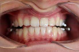 Annediekmann, 22 november 2012 #1. Braucht Ein Herbstscharnier Eine Feste Zahnspange Als Grundlage