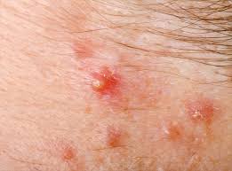 Image result for folliculitis symptoms